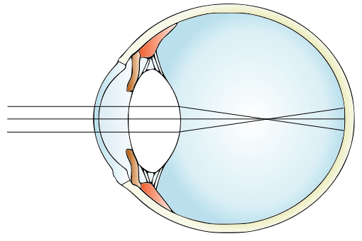 myopia