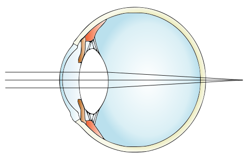 hyperopia