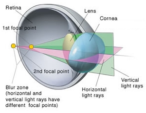 astigmatism