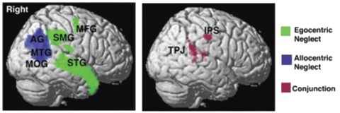 different areas of brain damage