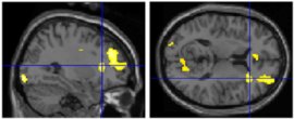 right insula activity