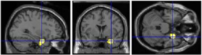 right amygdala activity