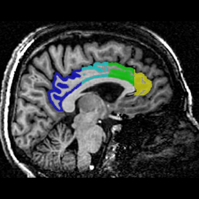 Sagittal MRI with manual cingulate parcellation