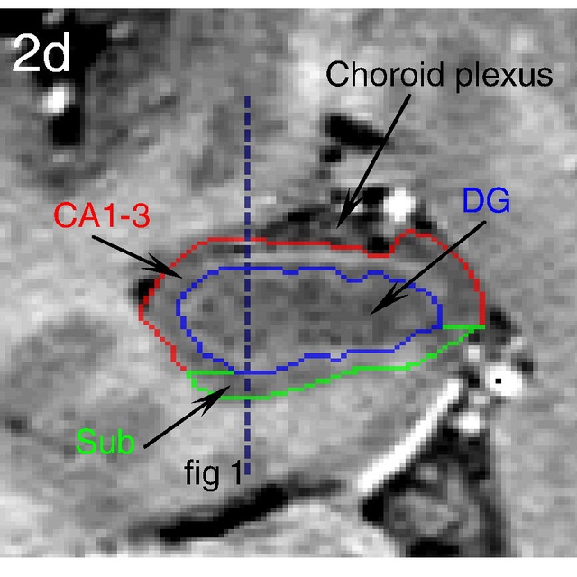Hippocampal subfield segmentation on MRI
