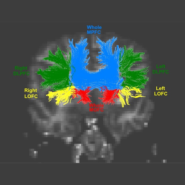 Diffusion tractography of prefrontal white matter pathways